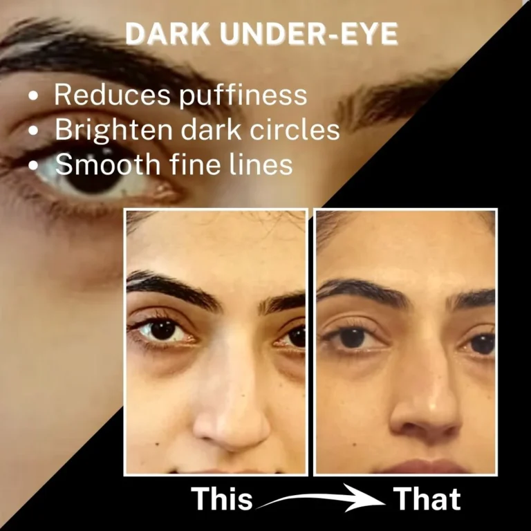 dark circles treatment naturally